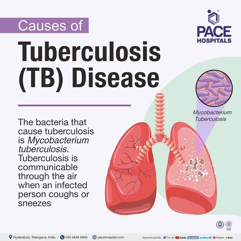 Tuberculosis Symptoms Types Causes Risk Factors Prevention